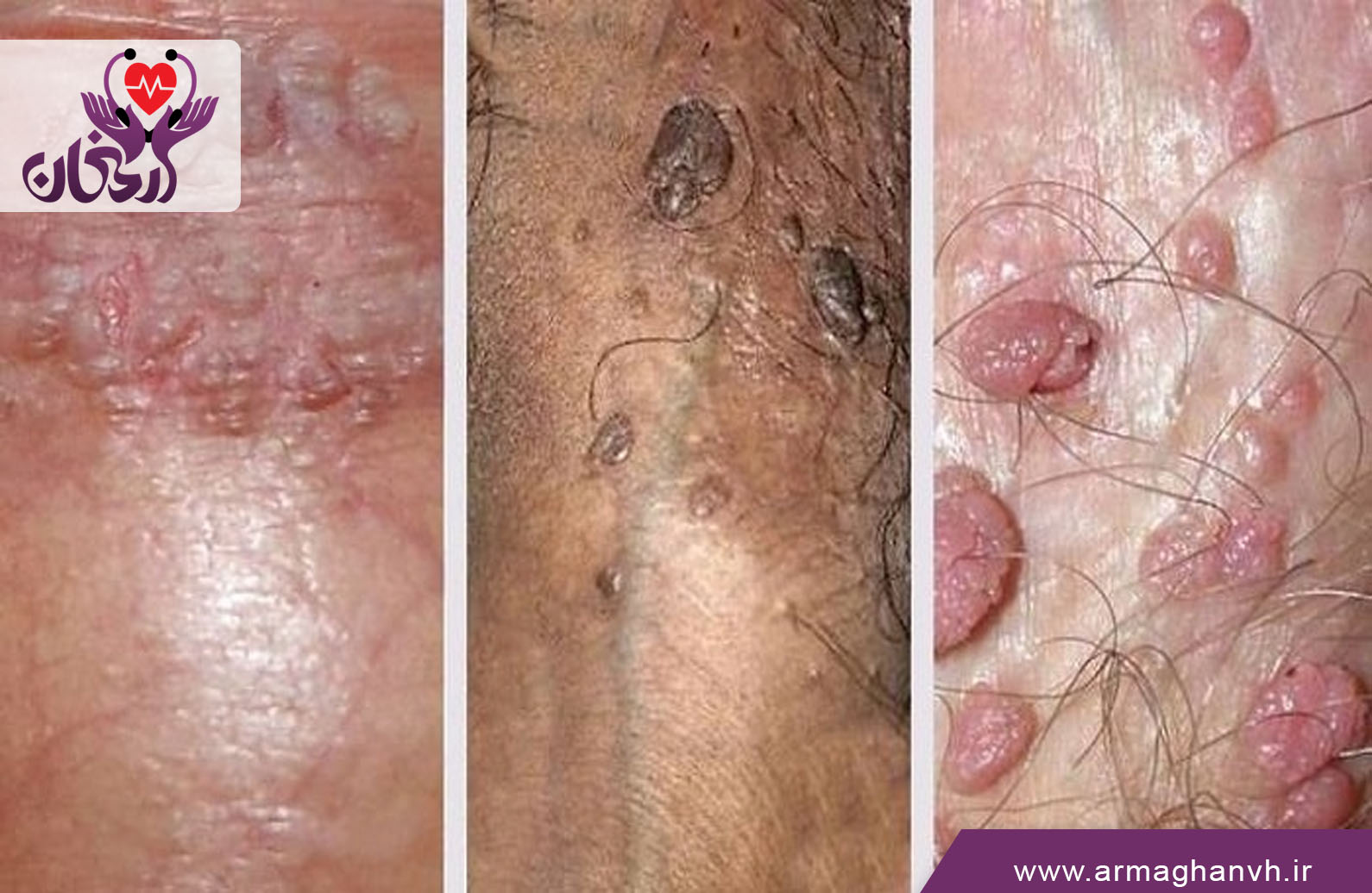 واکسن HPV