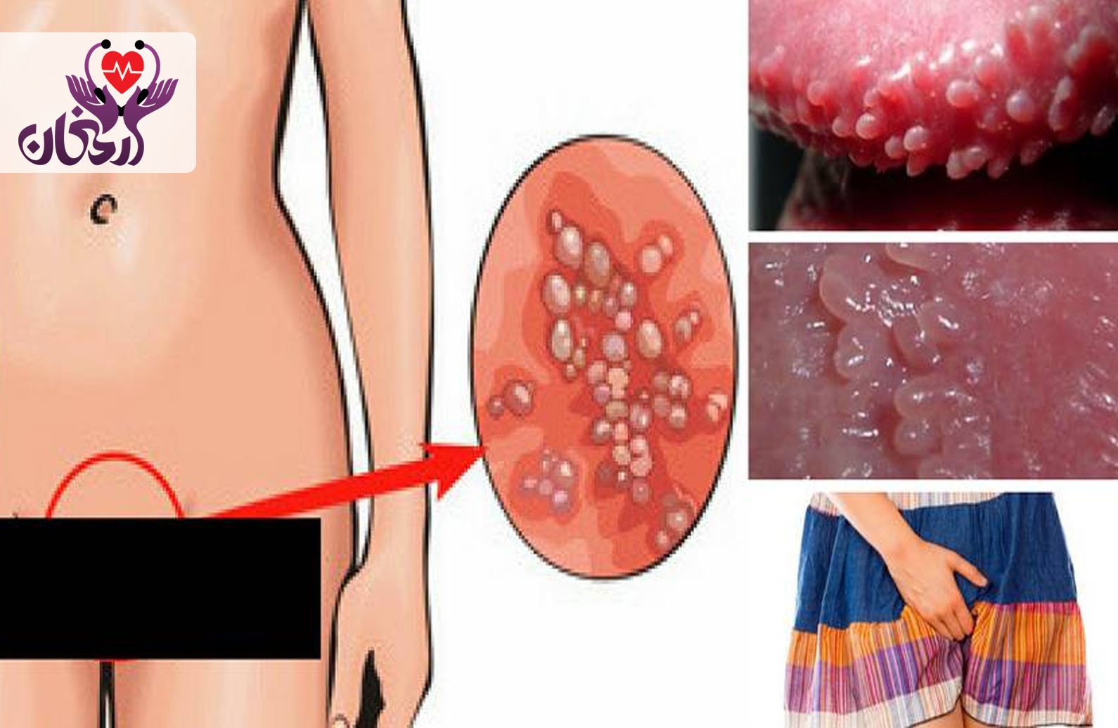 آیا زگیل تناسلی بدون رابطه جنسی منتقل می‌شود؟