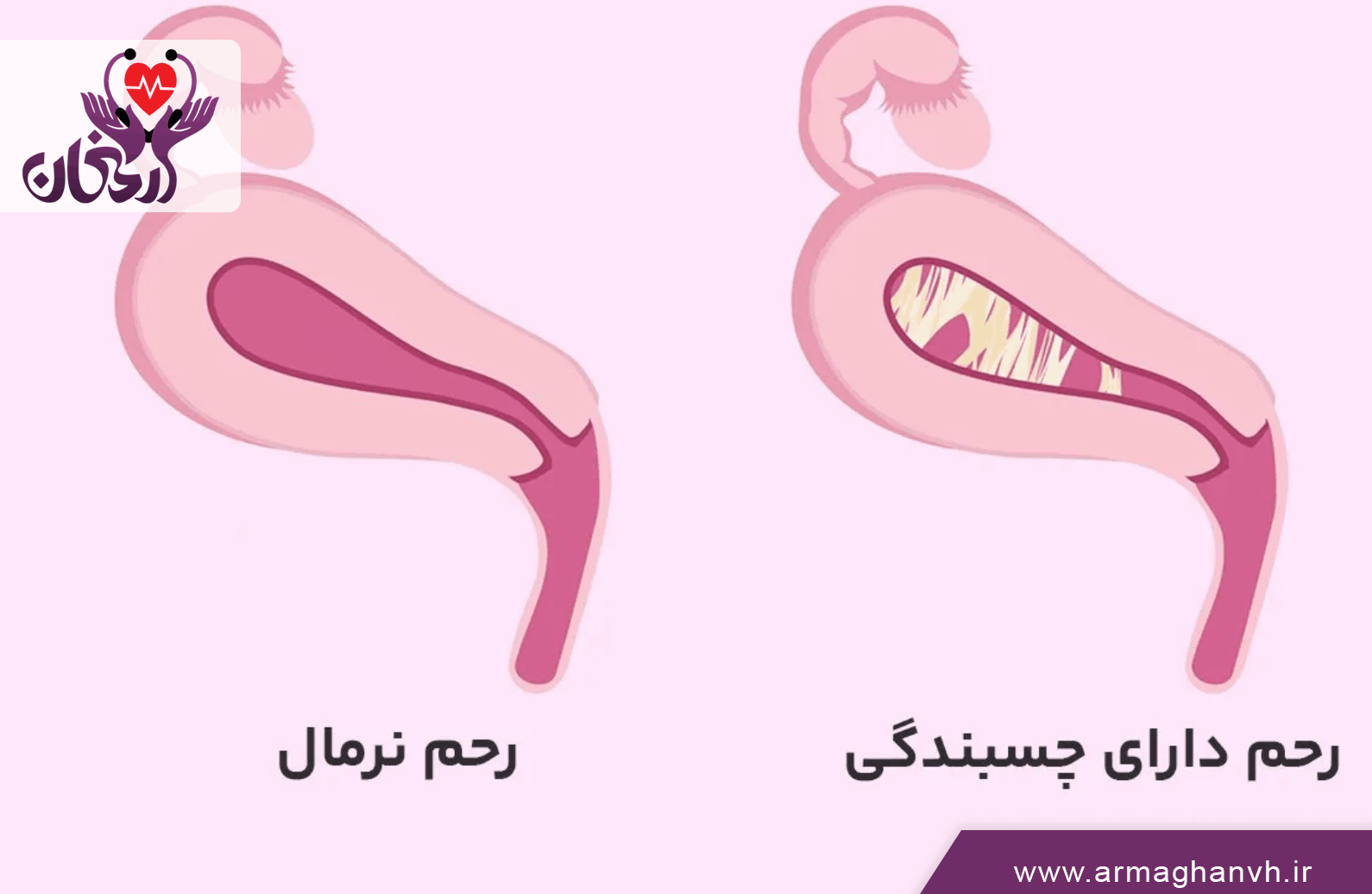 علل ایجاد چسبندگی رحم
