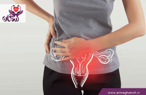علائم کیست تخمدان در دوران پریودی