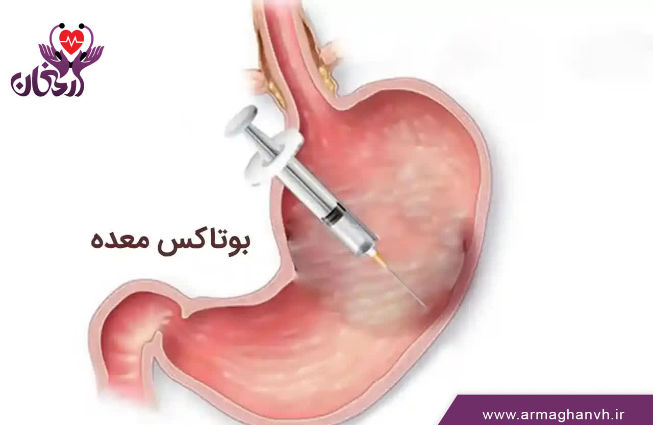 بوتاکس معده