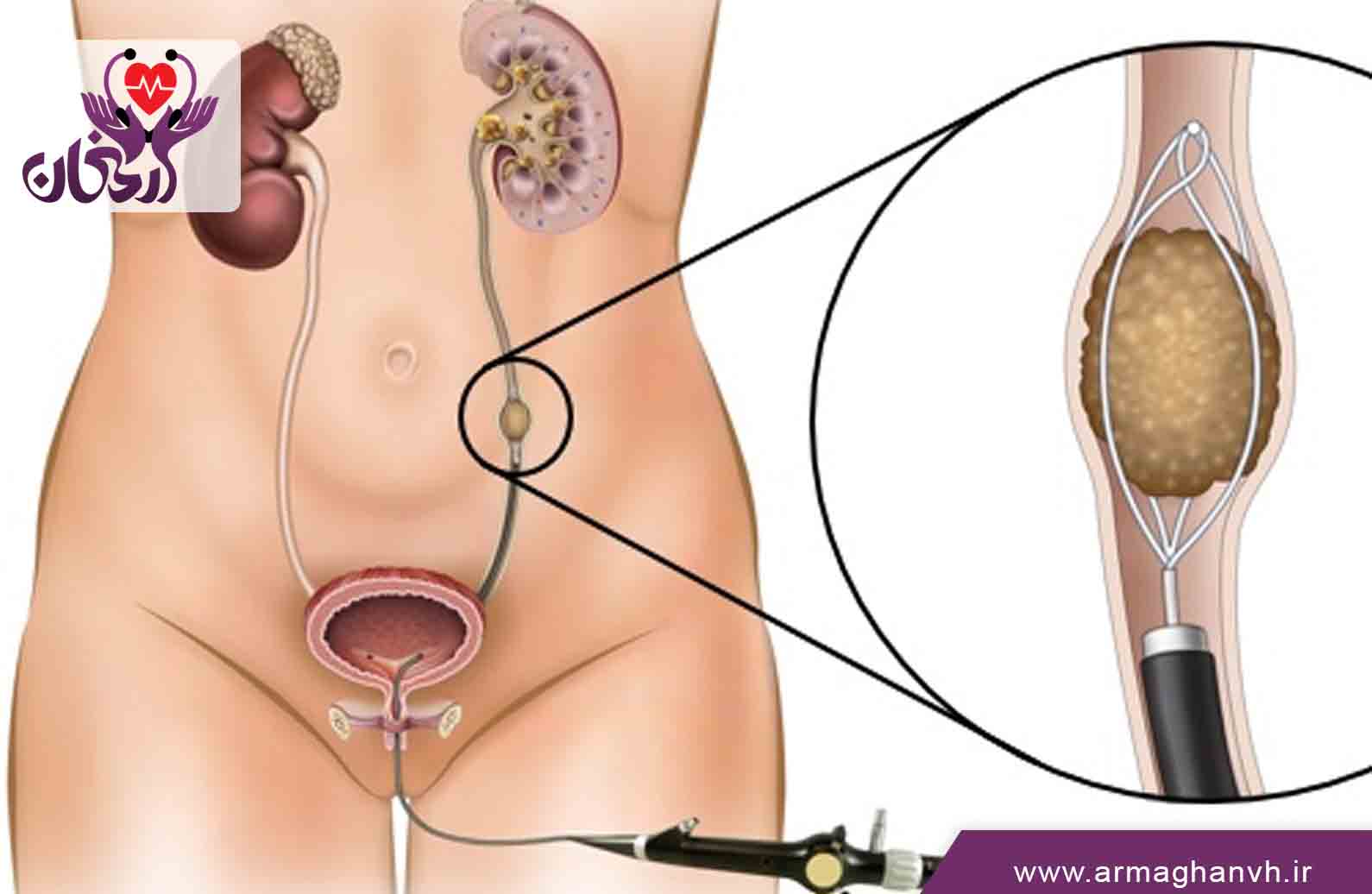 مراحل دفع سنگ کلیه و علائم ورود سنگ به مثانه