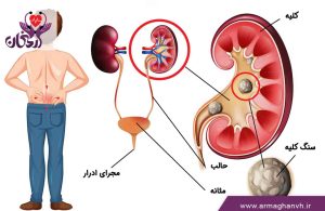 مراحل دفع سنگ کلیه و علائم ورود سنگ به مثانه