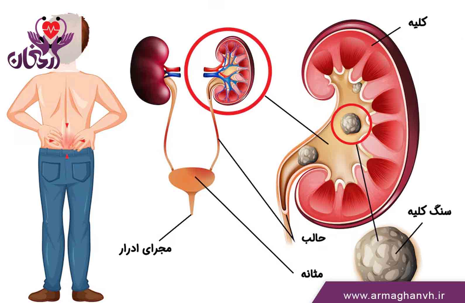 مراحل دفع سنگ کلیه و علائم ورود سنگ به مثانه
