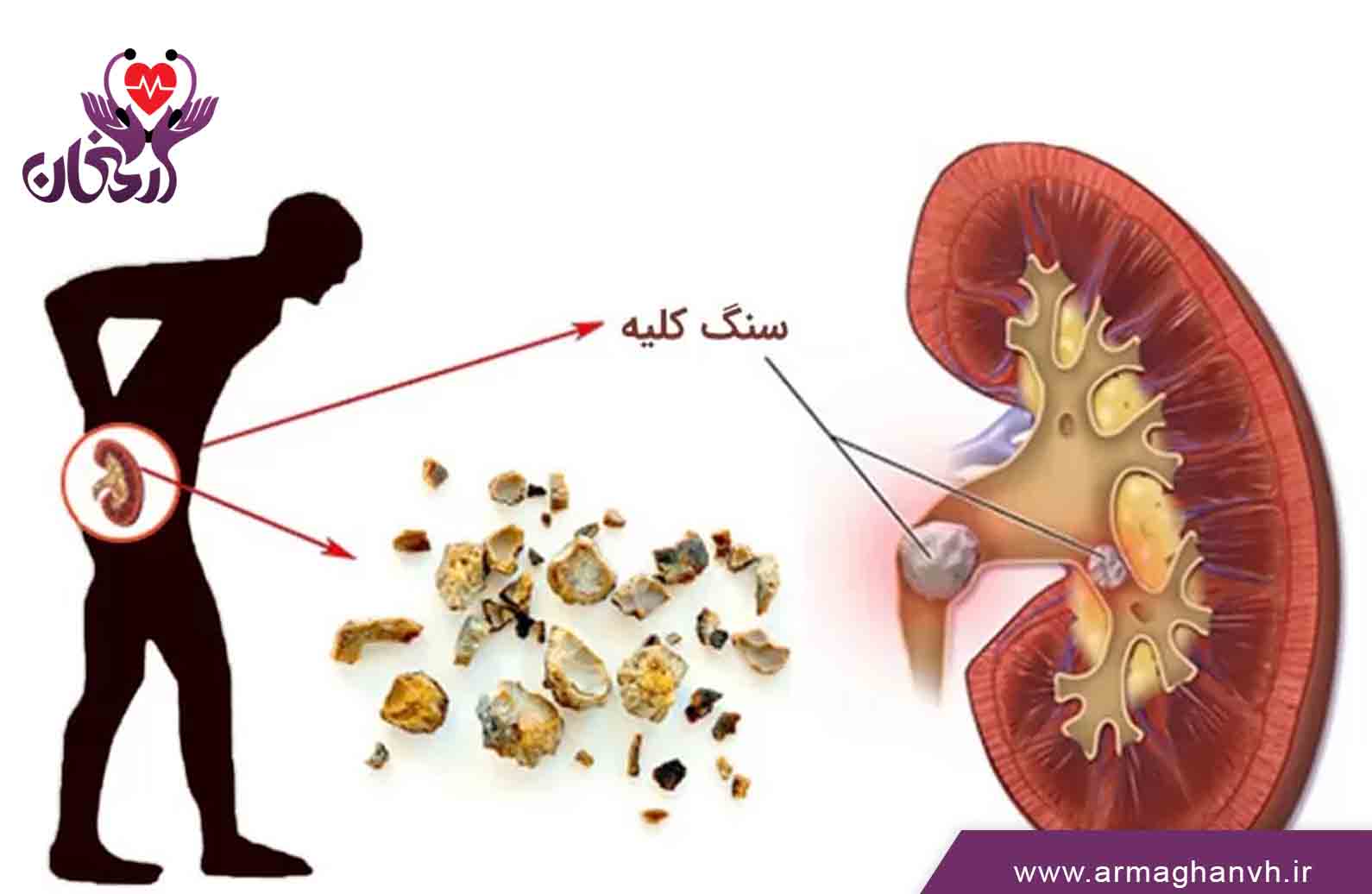 چه عواملی روی دفع سنگ کلیه تاثیر می گذارند؟